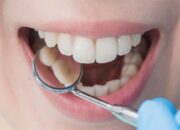 Kamu Punya Karang Gigi yang Sudah Mengeras? Begini Cara Menghilangkannya!