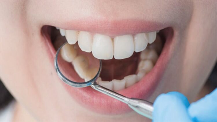 Kamu Punya Karang Gigi yang Sudah Mengeras? Begini Cara Menghilangkannya! 1 Ilustrasi karang gigi. (net)