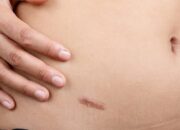 Usus Buntu, Hindari 6 Makanan Ini!