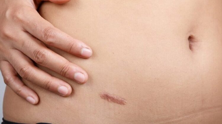 Usus Buntu, Hindari 6 Makanan Ini! 1 Ilustrasi bekas operasi usus buntu. (net)