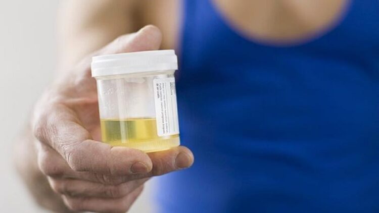 Kenali Tiap Makna Urine dari Warnanya, Bisa Jelaskan Kondisi Kesehatan Anda 1 Ilustrasi tes urine. (net)