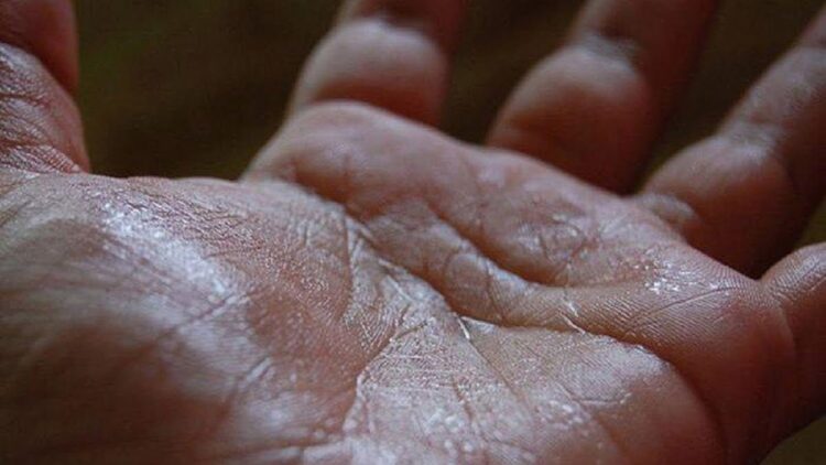 Tangan Berkeringat? Ini Pertanda Kondisi Medis Menurut Dokter 1 Ilustrasi telapak tangan berkeringat. (net)