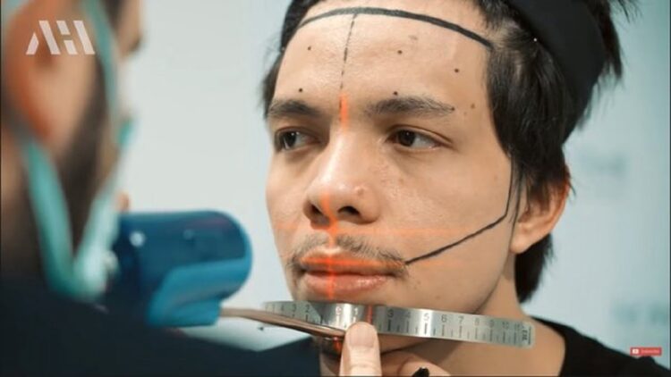 Setelah Anang, Giliran Atta Halilintar Transplantasi Rambut, Segini Biayanya 1 Atta Halilintar menjalani proses transplantasi rambut. (net)