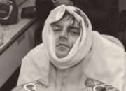 Berbenturan dengan Kawat Oktagon, Kepala Petarung MMA Ini Sobek 17 Jahitan