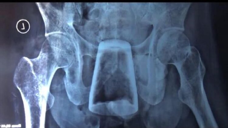 Heboh Temuan Gelas di Dalam Perut Pria di Jember, Kok Bisa? 1 Posisi gelas tidak benar-benar di perut, melainkan di rektum. (Foto: Yakub Mulyono)