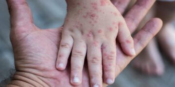 Portugal Laporkan 5 Kasus Cacar Monyet, Penularan Diduga lewat Hubungan Seks