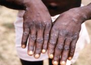 Kemenkes Sebut Belum Ada Laporan Kasus Cacar Monyet di Indonesia