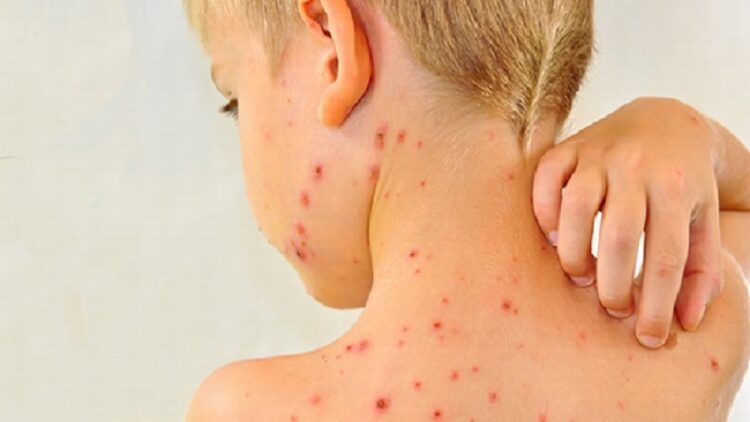Kasus Campak, Rubela dan Difteri di Indonesia Meningkat, Ini Penyebabnya 1 Ilustrasi campak. (net)