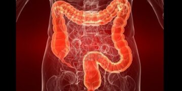 Waspadai 4 Macam Penyakit Usus Besar Ini 8 Waspadai 4 Macam Penyakit Usus Besar Ini