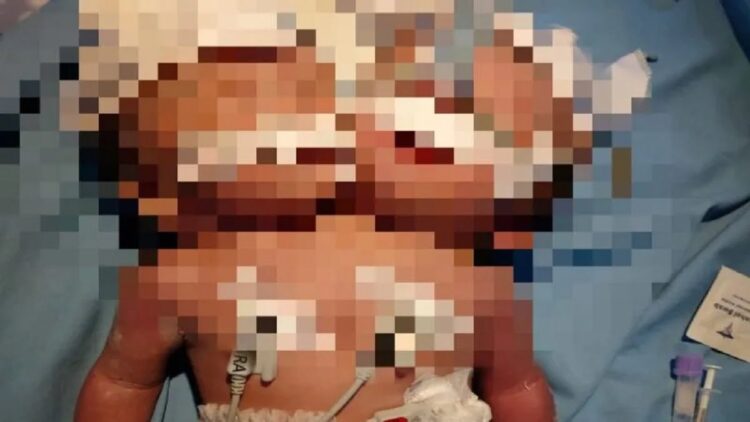 Bayi kembar siam asal Padangpariaman, Sumbar yang lahir di RSUD dr. Sadikin Kota Pariaman. ANTARA/Istimewa