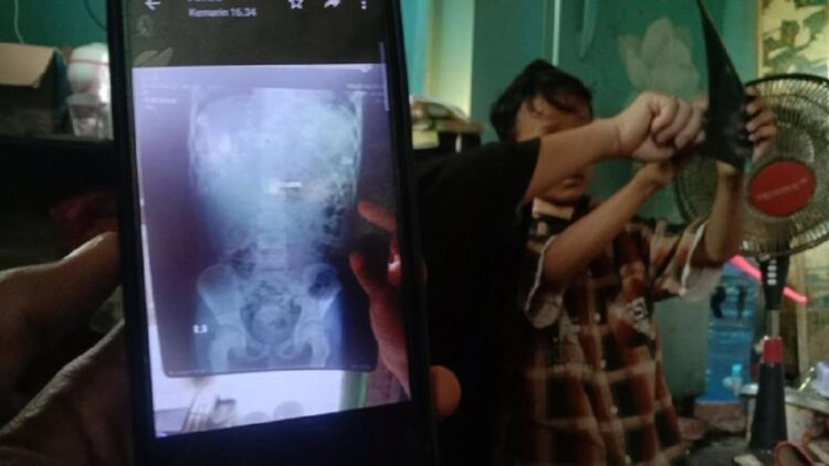 Zul (9) dan penampakan kunci yang tak sengaja ia telan di Indramayu (Foto: Sudedi Rasmadi/detikJabar)