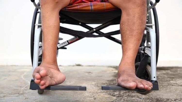 Ilustrasi penyakit polio. (net)