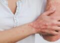 Psoriasis Bisa Muncul karena Stres dan Cuaca, Kenali Gejala dan Penanganannya