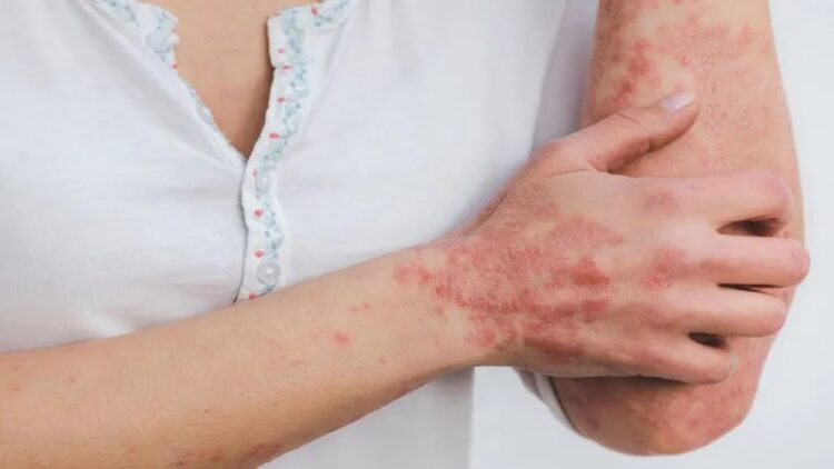 Psoriasis Bisa Muncul karena Stres dan Cuaca, Kenali Gejala dan Penanganannya 1 Ilustrasi psoriasis pada kulit. (ANTARA/Pixabay.com/Miller_Eszter)