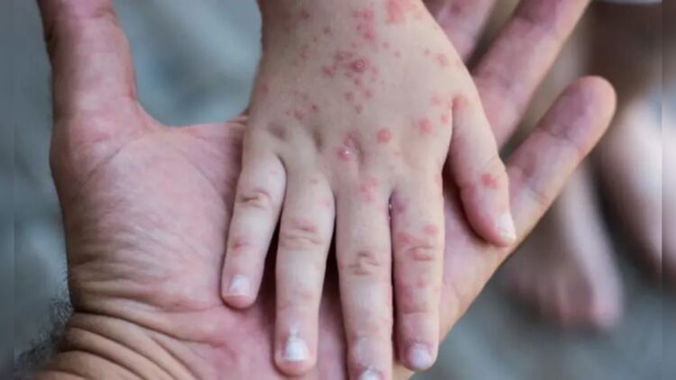 Ilustrasi cacar monyet. (Foto: Istimewa)