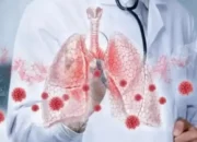 Mengenal Pneumonia Ganda, Infeksi Serius yang Serang Kedua Paru-paru