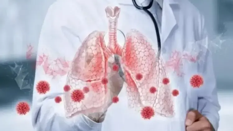 Mengenal Pneumonia Ganda, Infeksi Serius yang Serang Kedua Paru-paru 1 ilustrasi pneumonia ganda. (dok. istimewa)