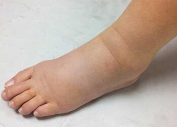 Pemkab Pasaman Barat masih Awasi 3 Kasus Kaki Gajah, Tidak Ada Penularan Baru